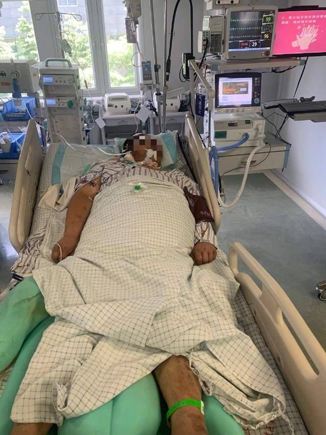 广东32岁快递员患热射病住进ICU，昏迷一个多月仍未醒